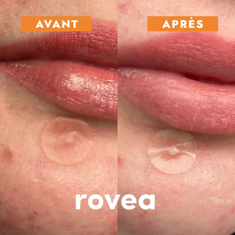 Patchs anti boutons et acné